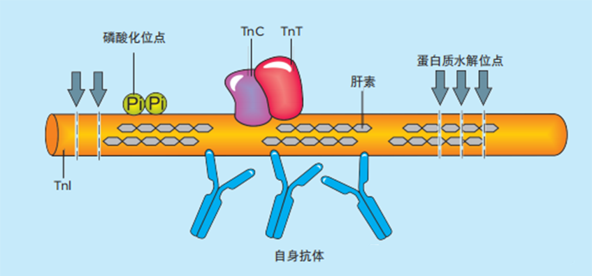 心梗患者血液中的 cTnI分子片段